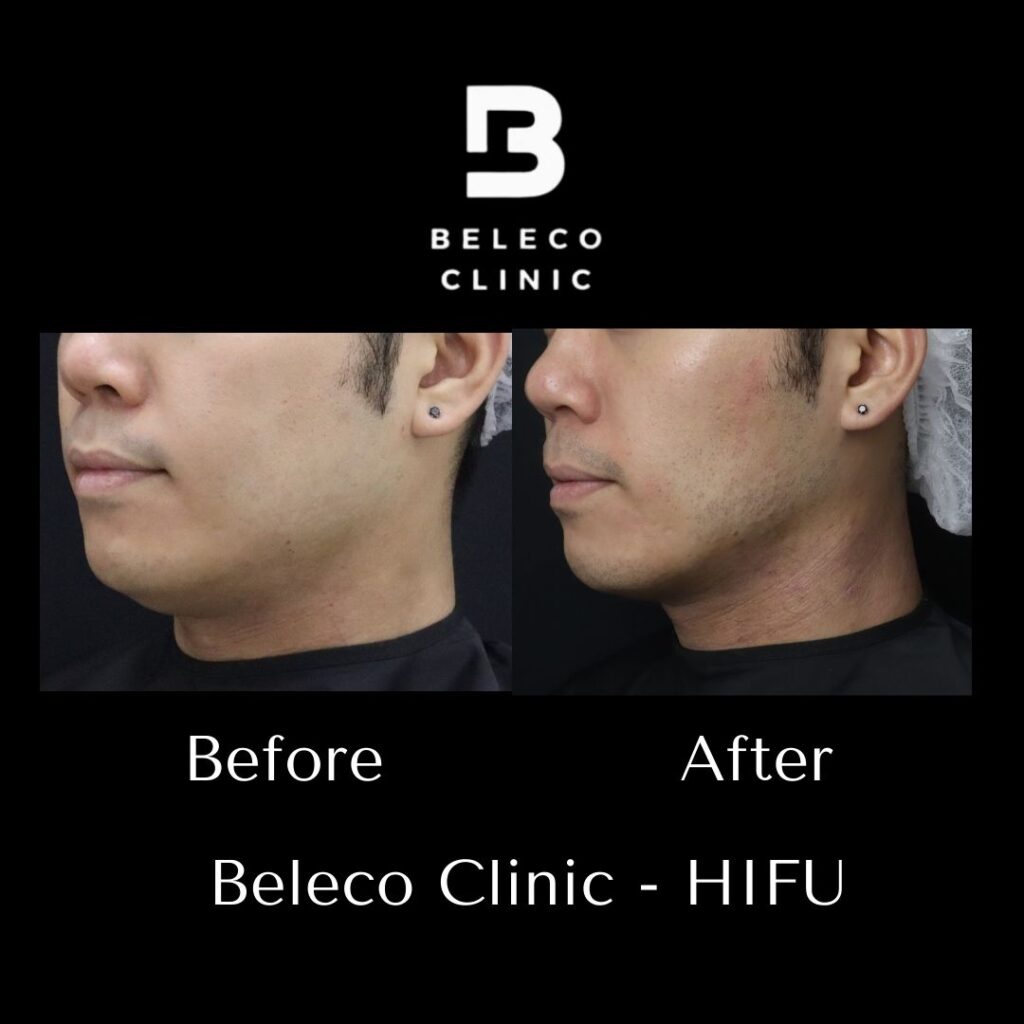 beleco clinic before and after hifu