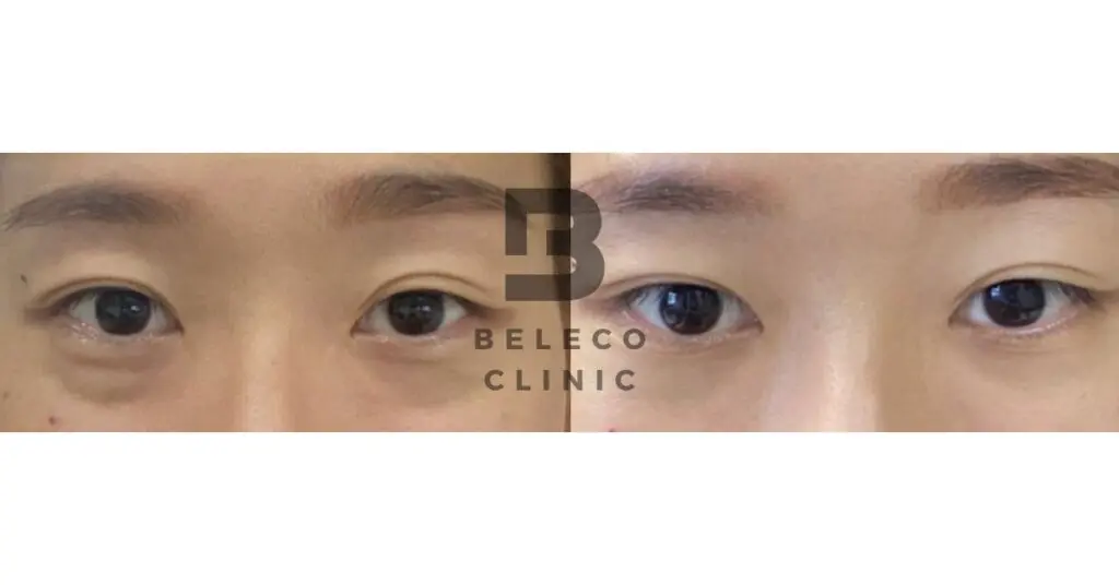 Eyebag Removal before and after 2