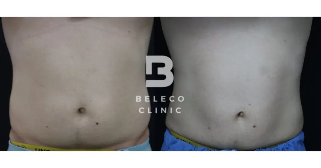 Clatuu Alpha Before After (Tummy)