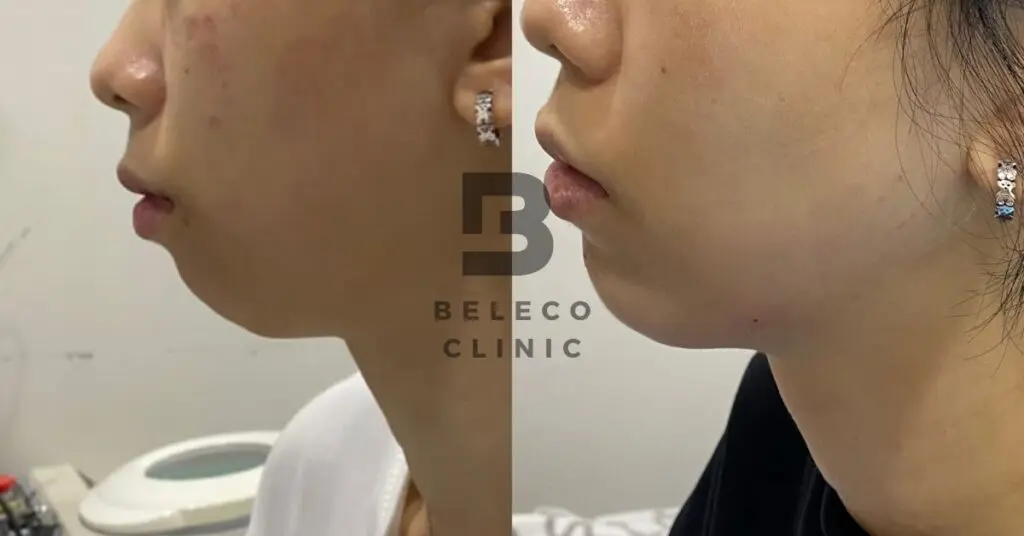 Dermal Filler Chin