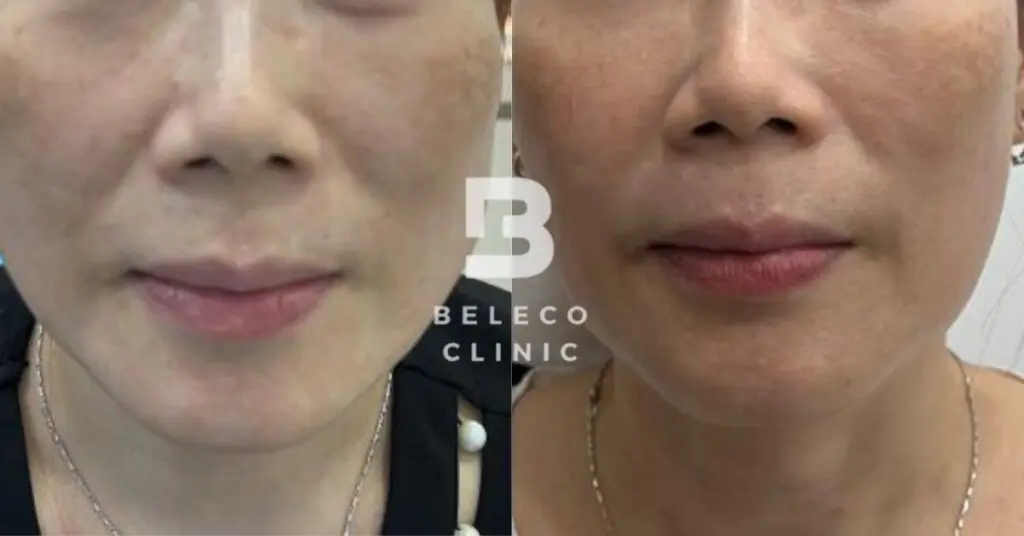 Sculptra before and after 1