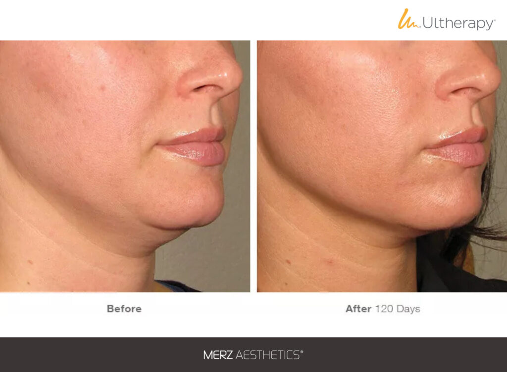 Ultherapy Prime chin before after