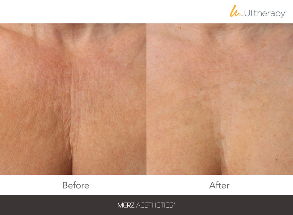 Ultherapy Prime decollete before after