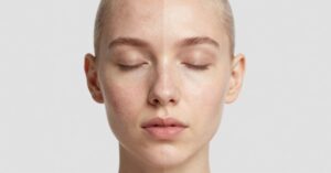 acne scars type treatment